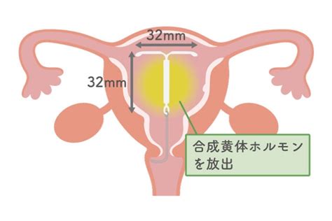 ミレーナ 中出し|「ミレーナの避妊について」に関する医師の回答